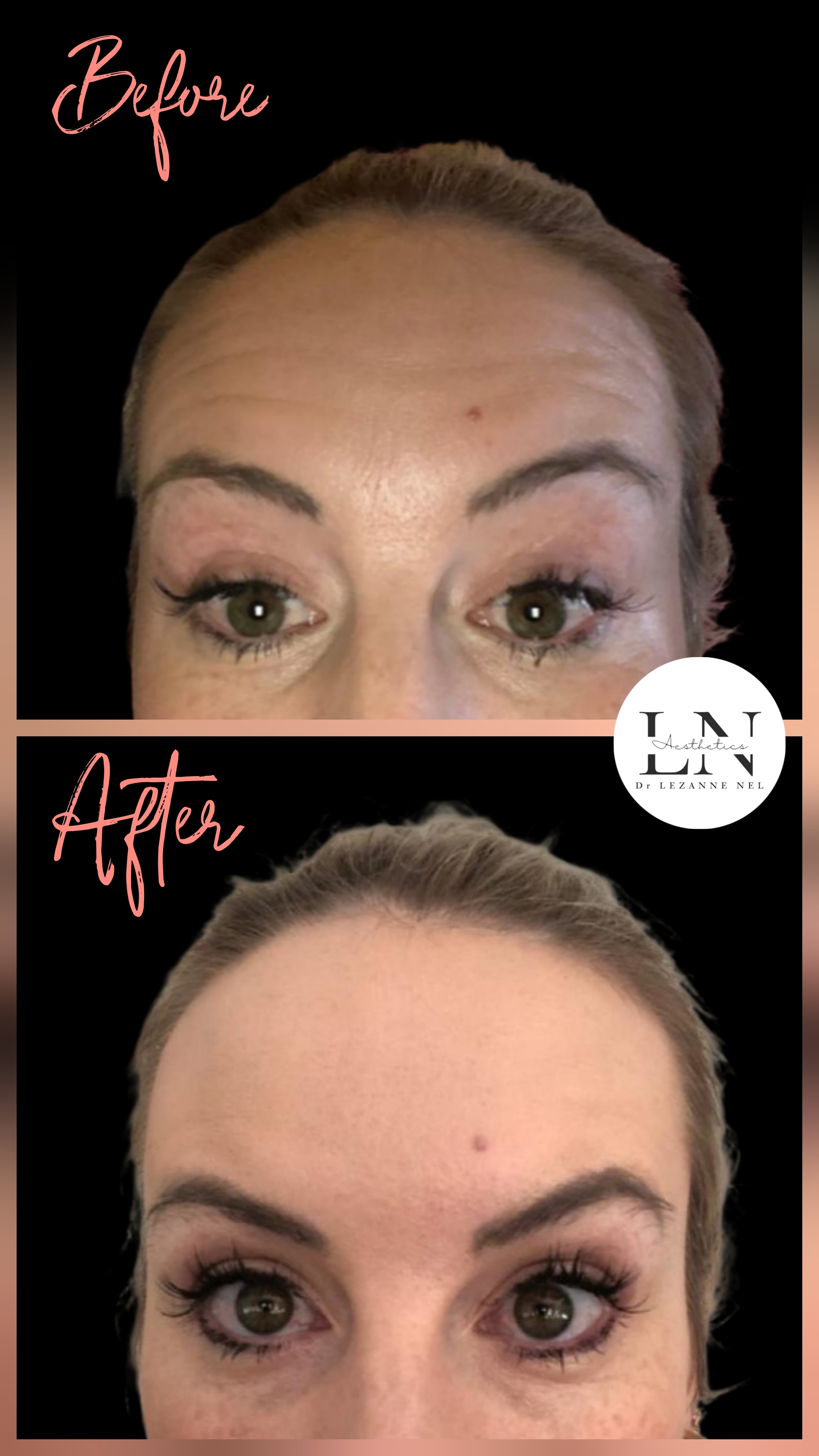 Before and after anti-ageing toxin treatment