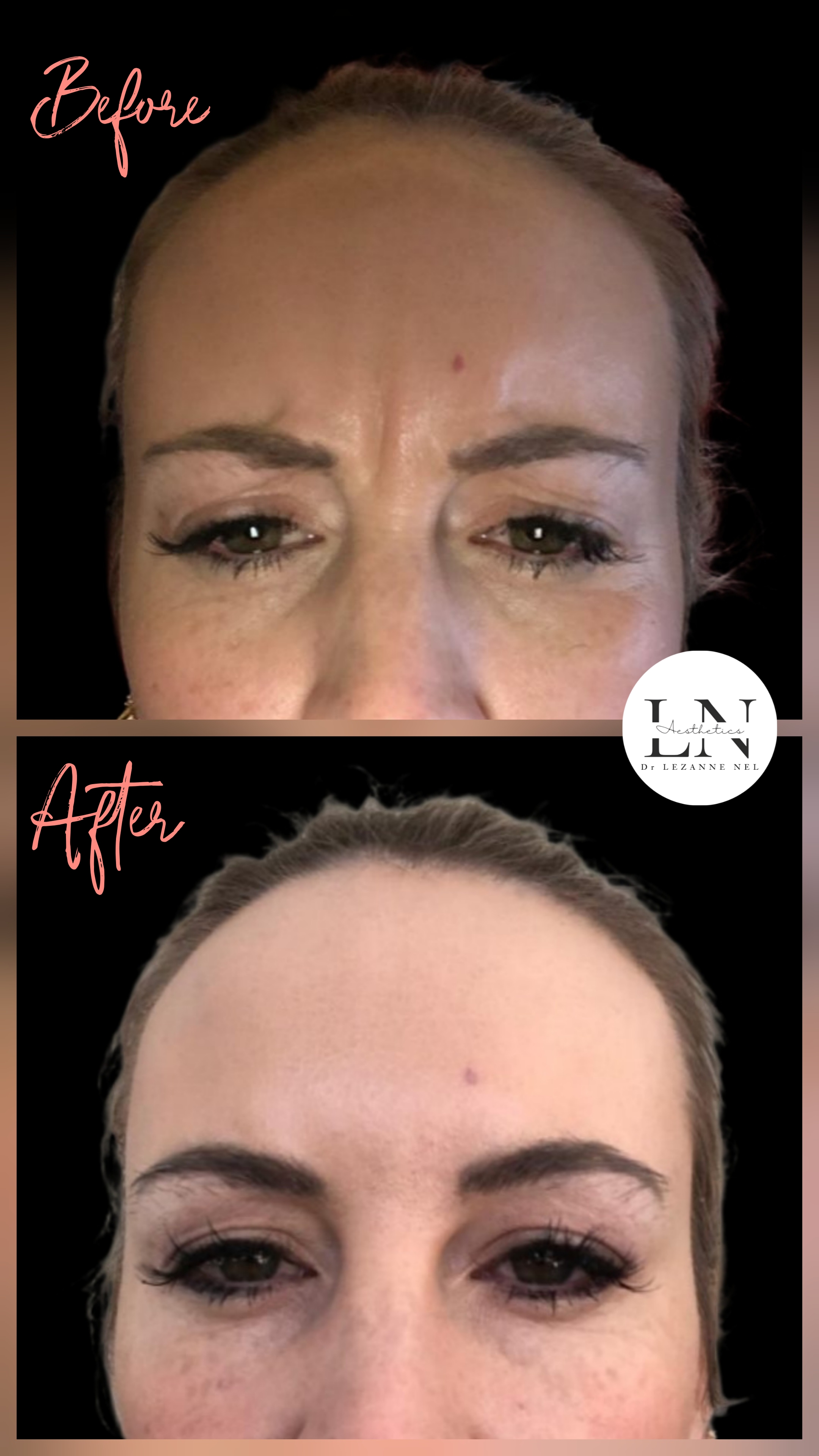 Before and after frown line treatment