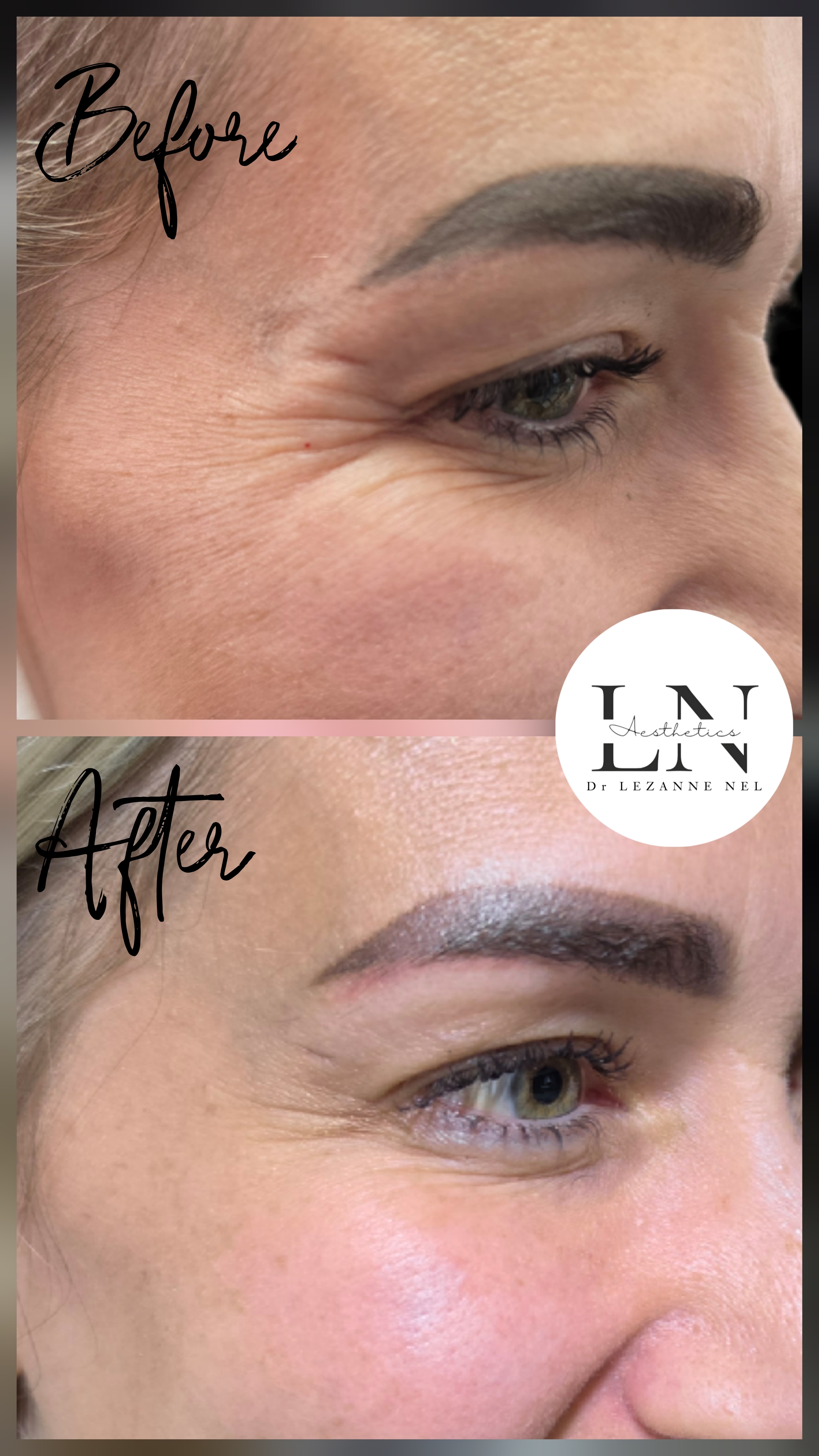 Before and after crow's feet treatment